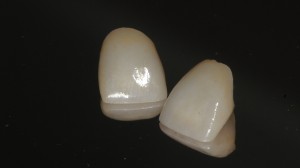 Dental Crowns