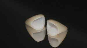 Dental Crowns