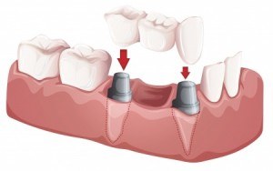 dental bridges