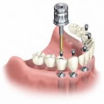 Implant-Supported Dentures