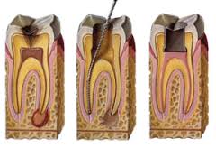 Root Canal Therapy Dentist