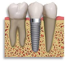 Implant Supported Crown & Bridge Dentist
