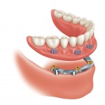 Implant-Supported Dentures