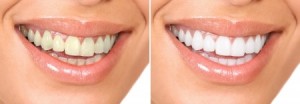 teeth whitening north canton
