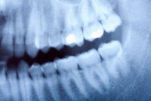 X-Ray (Radiographic) Regimen